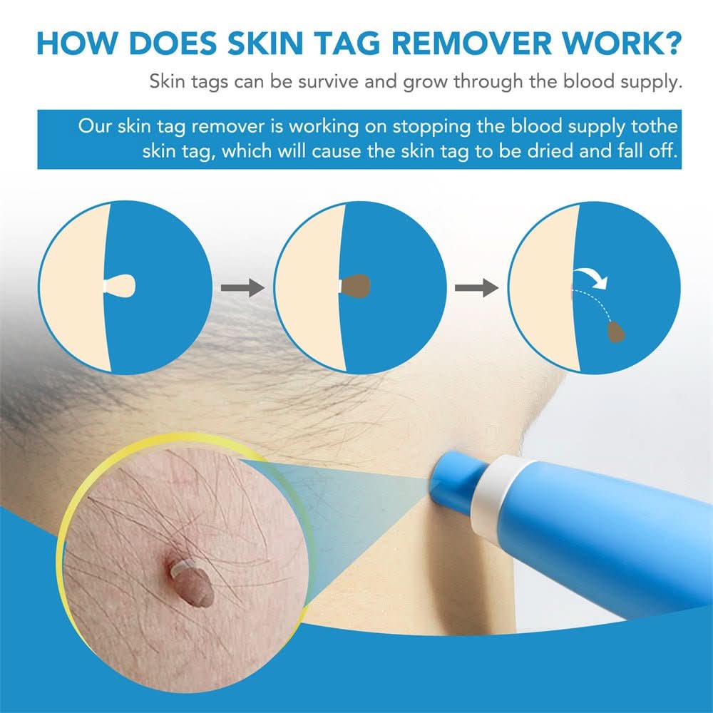 Dermaswift – Hautfleckenentferner Gegen Warzen Und Haut Anhänger