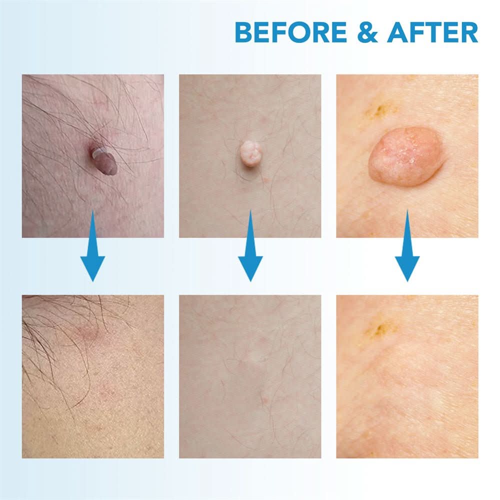Dermaswift – Hautfleckenentferner Gegen Warzen Und Haut Anhänger